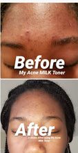 Load image into Gallery viewer, Zuri's Acne Milk Toner - Large ((DOES NOT Contain Dairy))
