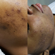 Load image into Gallery viewer, Zuri's Acne Milk Toner - Large ((DOES NOT Contain Dairy))
