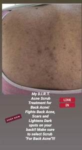 Zuri's D.I.R.T. Back Acne Scrub (For Back Acne ONLY!!)